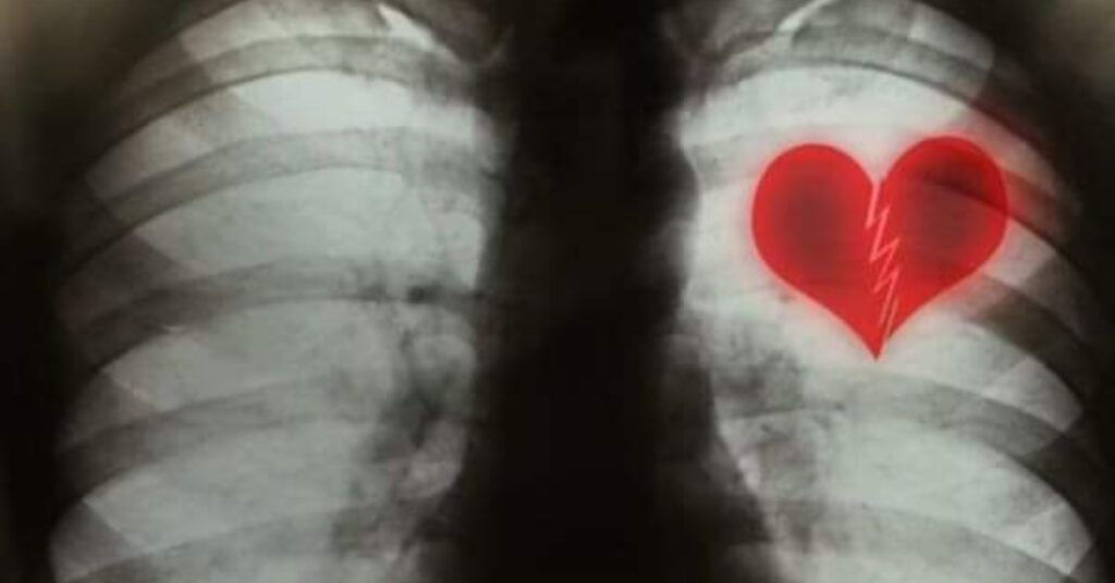 Sindromul Inimii Frânte: Mai Mult Decât un Mit